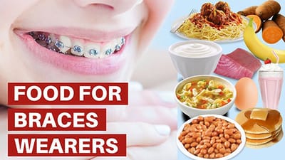 What Are The Soft Foods Ideal To Consume When Wearing Braces?