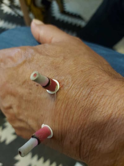 סו ג'וק עוזרת לאי ספיקת כליות