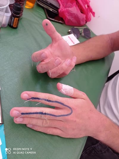 כך נראים כפות ידיים בטיפול סוג'וק