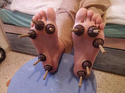 טיפול באי ספיקת כליות ותסמונת נפרטיטית