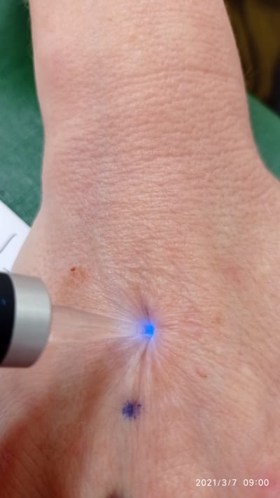 טיפול בצבעים מכשיר אור