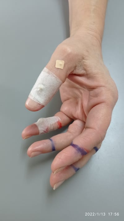 טיפול סוג'וק לתתרנות