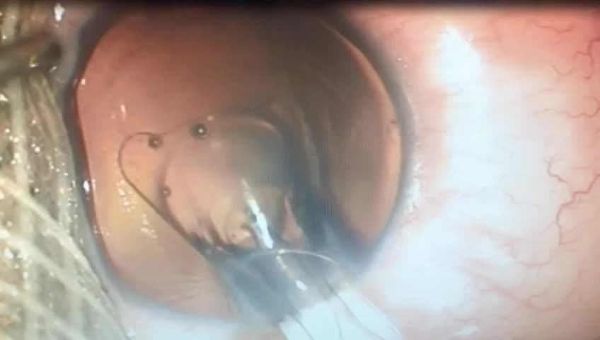 Chirurgie de   L’Implant Phaque du "Fort Myope" ...