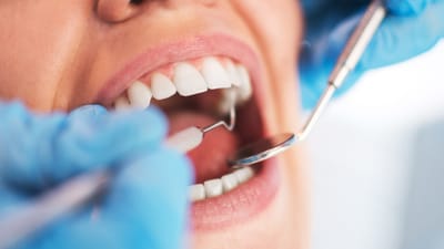 Veneers Cost Near Me - What You Need to Know