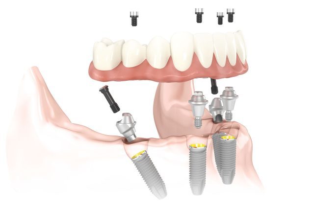 Nobel Biocare All on 4 / Straumann SLA All on 4 (SWISS)