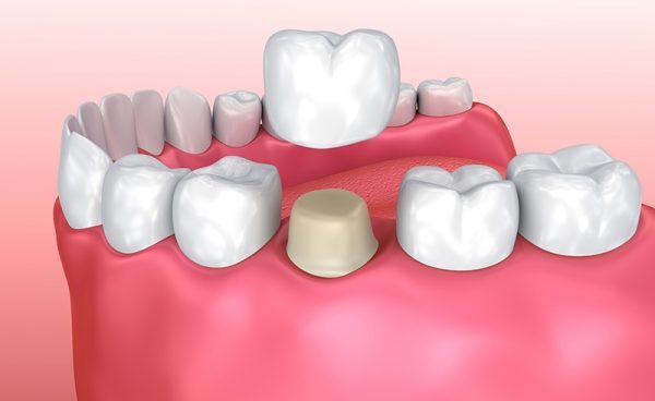 Emax/Cercon full porcelain crown (Germany)