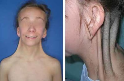 SINDROME DE TURNER