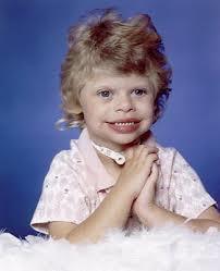 SINDROME DE WILLIAMS