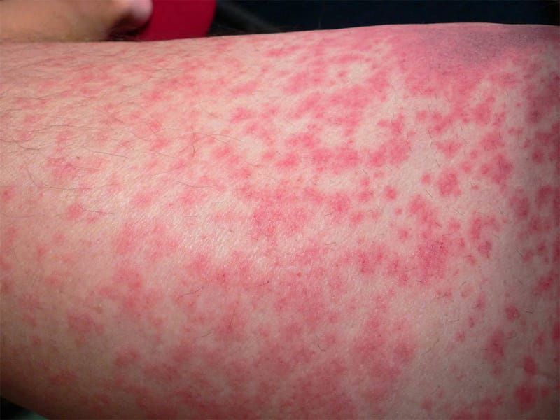 Alergias/ Anafilaxia