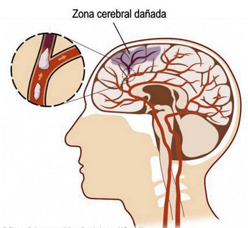Embolia Cerebral