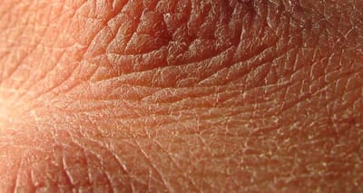 Dry Scaly Skin