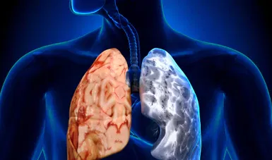 11 De Noviembre "Día Mundial de la Enfermedad Pulmonar Obstructiva Crónica"