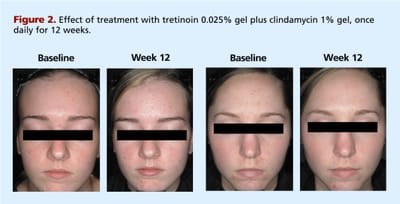 Jakie jest najlepsze lekarstwo na zaburzenia erekcji?