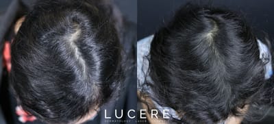 PRP Treatments for Hair Loss: Everything You Need to Know About This Effective Solution