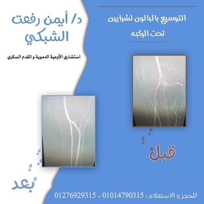 انسداد الشرايين الطرفية