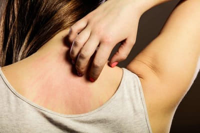 Lamictal Rash Or Reactions From Lamotrigine image