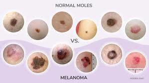 Giornata del Melanoma image