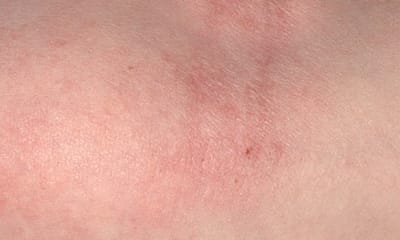 Bagaimana Eksim Terlihat? Gambar Lengkap