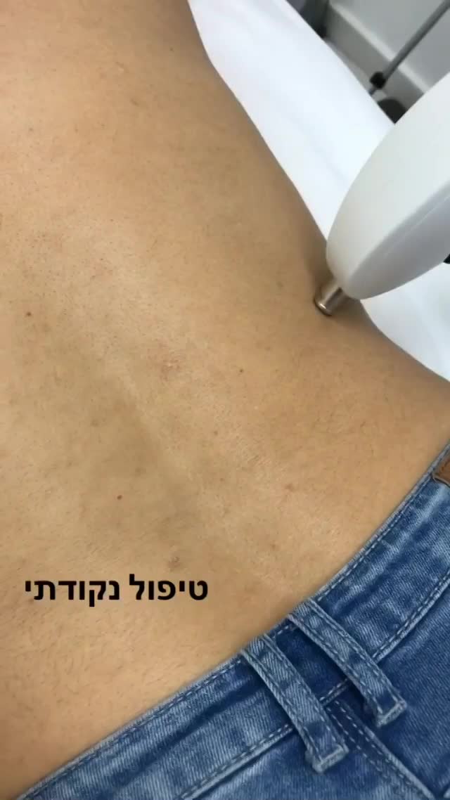 הסרת צלקות במכשיר אקסנט