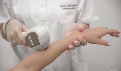 הסרת שיער בלייזר- SOPRANO