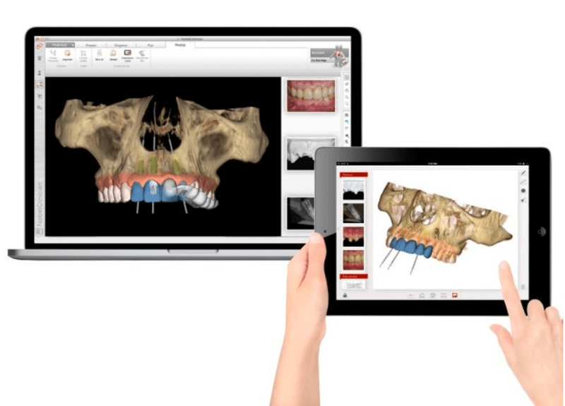 Implantologia Computer Guidata