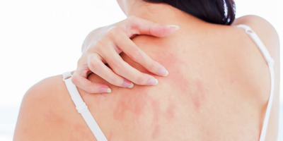 Natural remedies for dermatitis you should know
