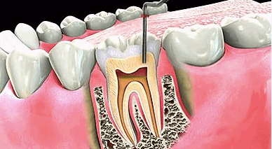 Root Canal Treatment