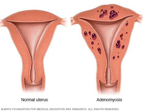 Adenomyosis