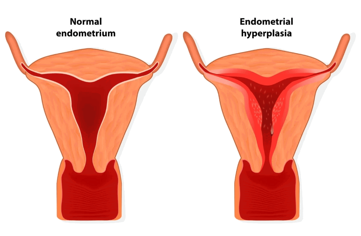 Hiperplasia