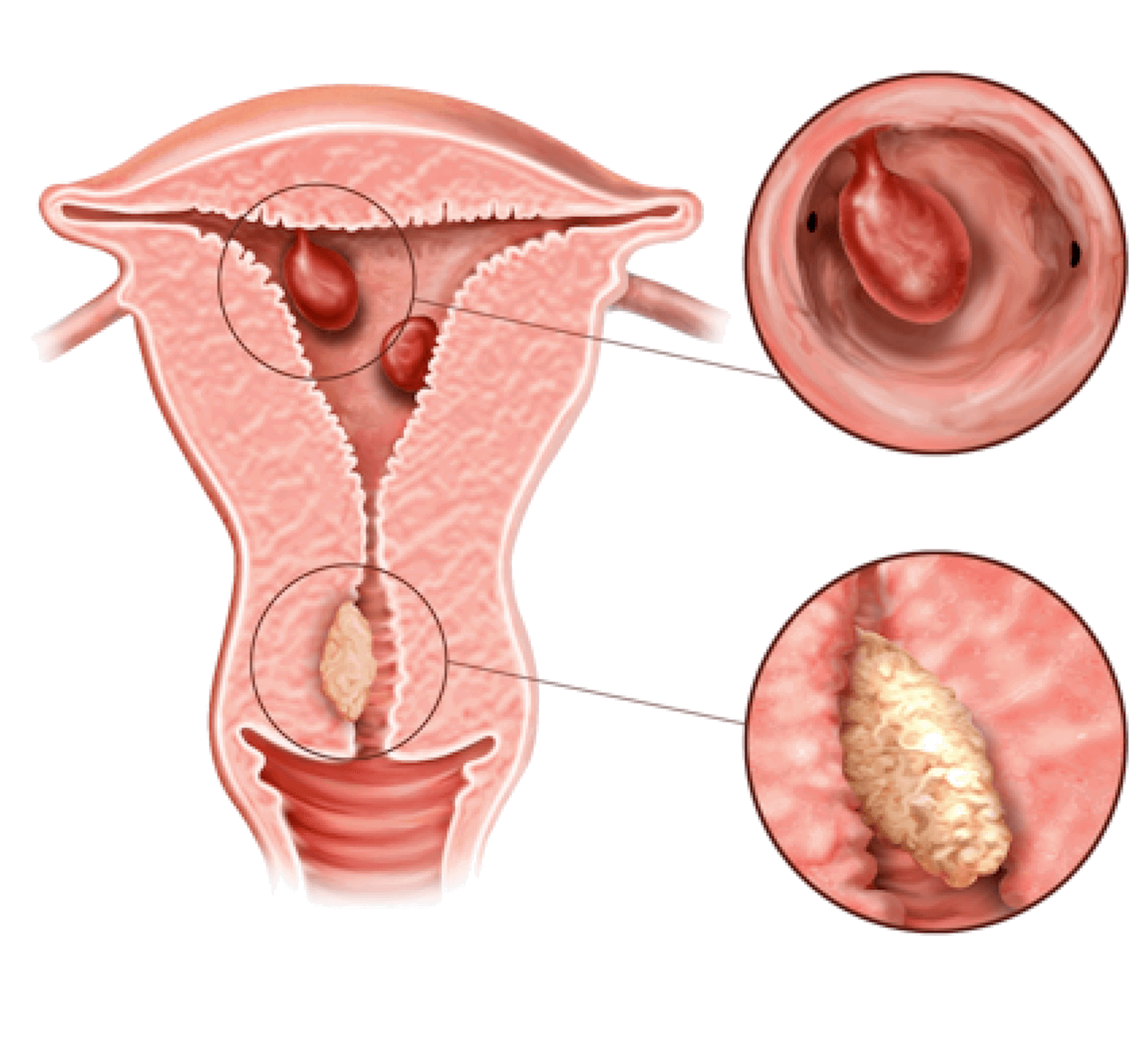 Polyps