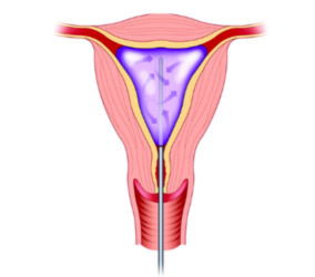 Endometrial Ablation