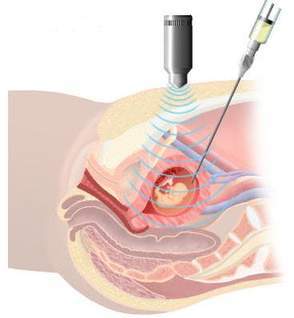 Amniocentesis