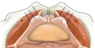 Burch Retropubic Urethroplexy