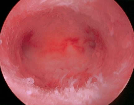 Hysteroscopy