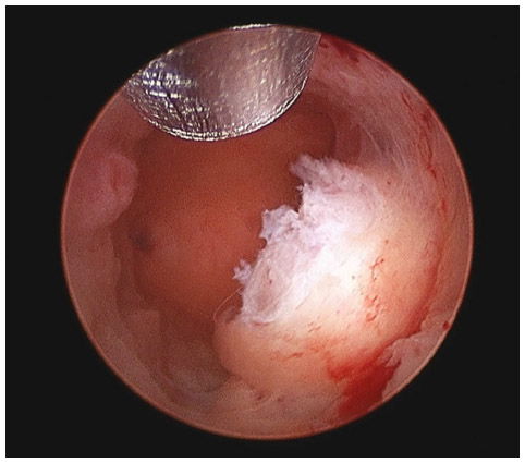 Transcervical Resection of Endometrium