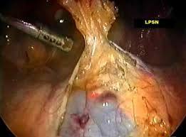 Presacral Neurectomy