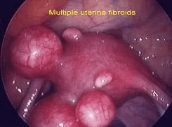 Tratamientos de fibromas