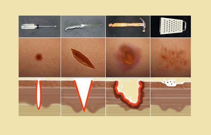 Clasificación de las Heridas según agente causal