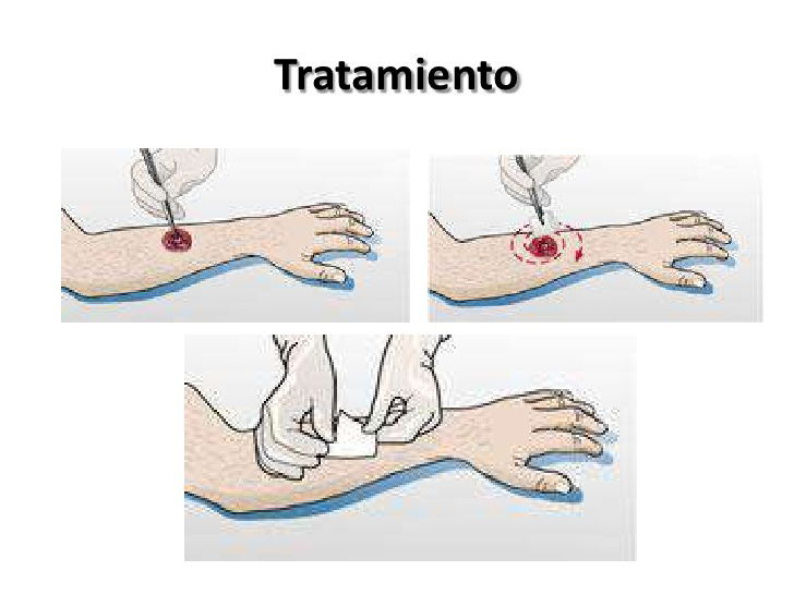 Tratamiento de las Heridas simples