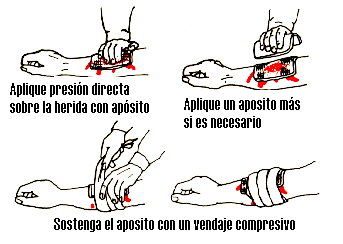 ¿Cómo detener una hemorragia externa?