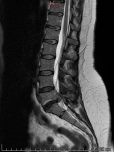 Intervertebral Disc Regeneration