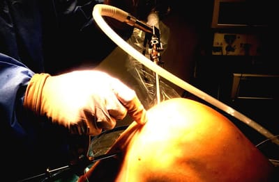 Chirurgia Artroscopica image