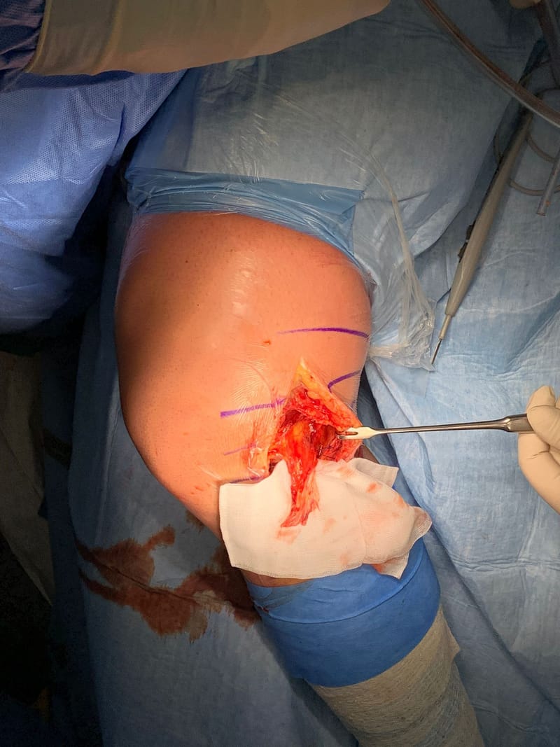 Classificazione delle lesioni del LCM e trattamento