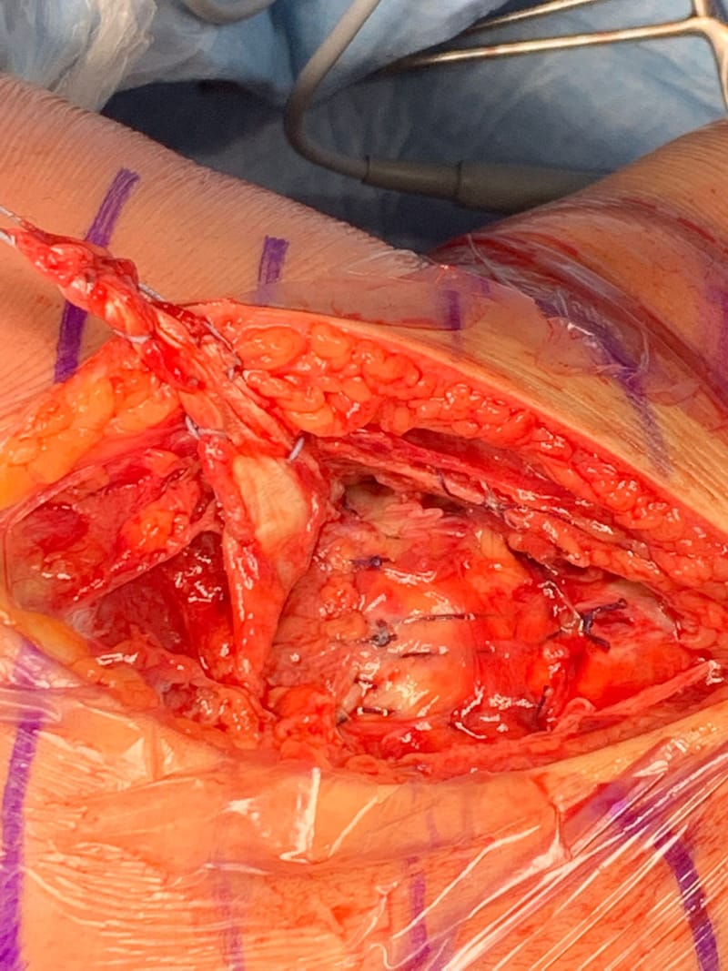 Classificazione delle lesioni del LCM e trattamento