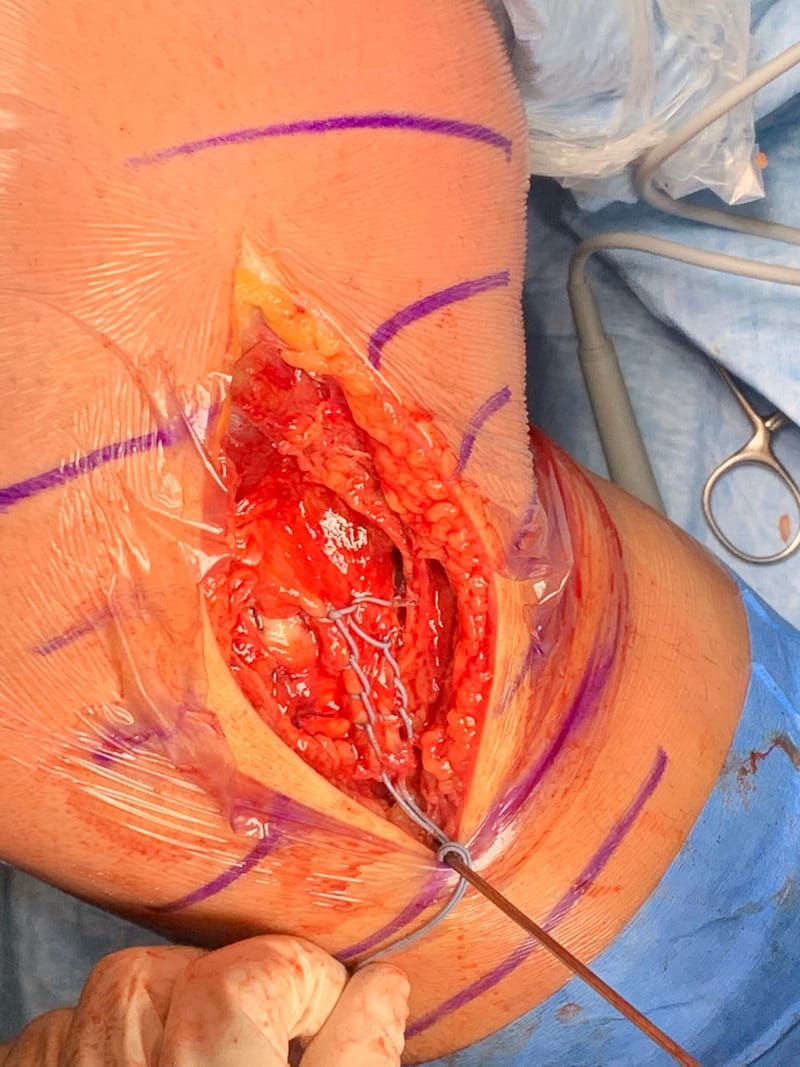 Classificazione delle lesioni del LCM e trattamento