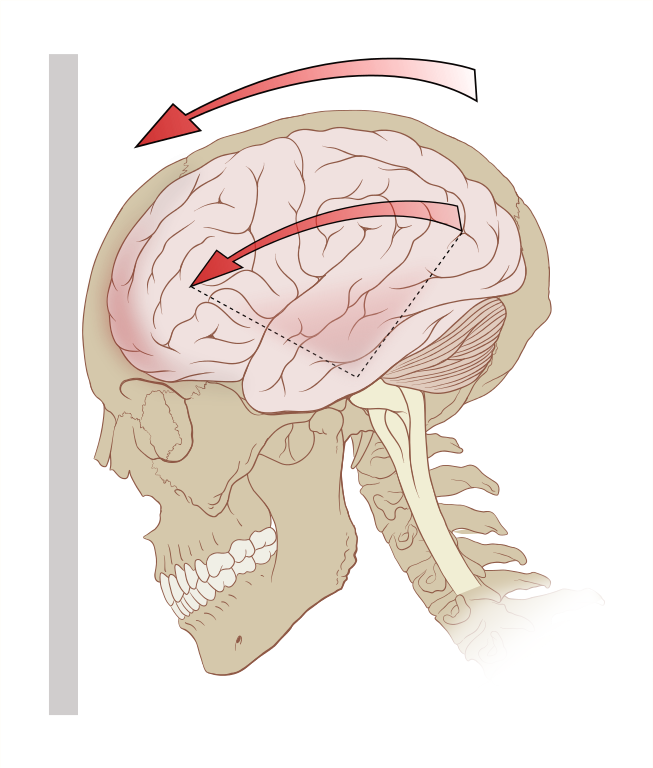 Concussion Information