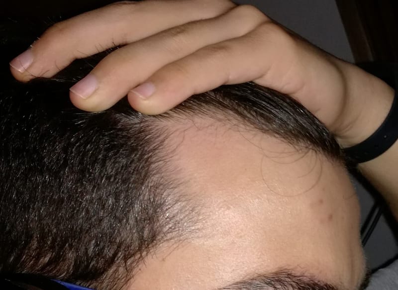 Difference Between the Mature Hairline and Receding Hairline