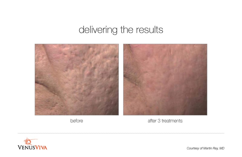 Resurfaçage de la peau