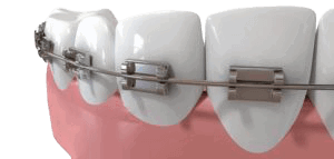 Metal Braces image