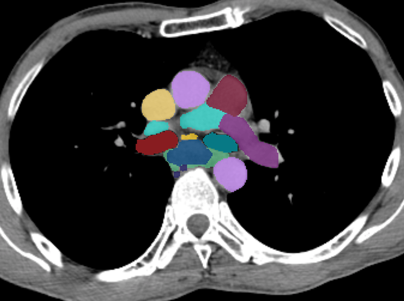 Esophageal cancer